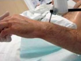 Incidencia de cáncer en pacientes trasplantados es más alta