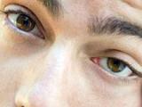 Niveles de ECP determinan severidad de la queratoconjuntivitis atópica