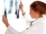 Capacidad funcional predice la supervivencia en el carcinoma pulmonar no microcítico