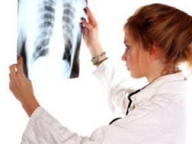 Capacidad funcional predice la supervivencia en el carcinoma pulmonar no microcítico