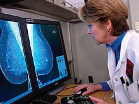 Densidad mamaria eleva la posibilidad de cáncer