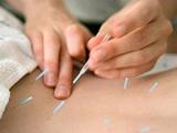 La acupuntura alivia el dolor crónico