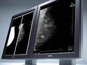 Densidad mamográfica está relacionada con el cáncer de mama