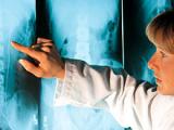 Manejo quirúrgico de la espondilolistesis es superior al abordaje conservador