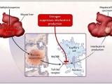 Carcinoma hepatocelular, un problema de género