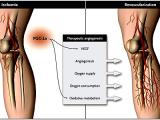 Angiogénesis terapéutica: realidad y ficción