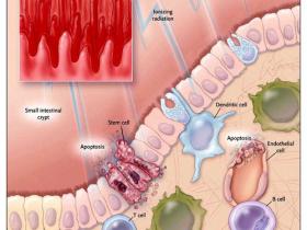 Cuando el intestino sobreviva a la radioterapia