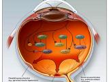 Edema retinal, una gota a la vez