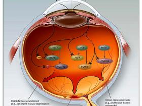 Edema retinal, una gota a la vez