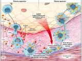 ¿Puedo revertir totalmente la aterosclerosis?