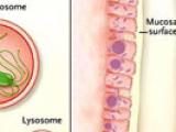 El camino a la enfermedad de Crohn