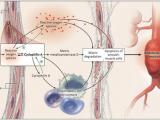 Conozcamos al aneurisma aórtico abdominal