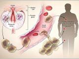 Acorralando al cáncer de próstata