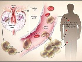 Acorralando al cáncer de próstata