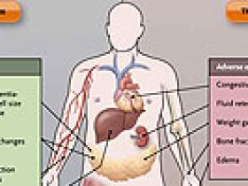 Obesidad y diabetes, caprichos de la naturaleza