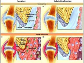 Artritis reumatoide y articulaciones