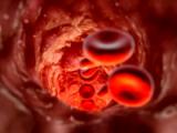 Anticoagulación mejora la supervivencia en el cáncer de pulmón microcítico