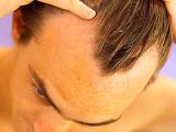 La alopecia genera más cardiopatías