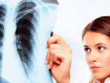 Variación en MUC5B mejora la supervivencia en la fibrosis pulmonar idiopática