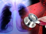 Riociguat demuestra beneficios en la hipertensión pulmonar