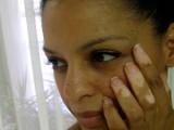 El vitiligo puede desarrollarse en pacientes con melanoma uveal