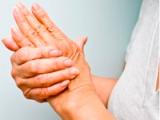 Apremilast alivia signos y síntomas de la artritis psoriásica
