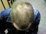 Bajas dosis de interleucina 2 revierten la alopecia areata
