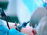 Cirugía laparoscópica reduce recurrencia de la hernia femoral