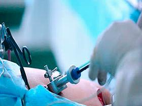 Cirugía laparoscópica reduce recurrencia de la hernia femoral
