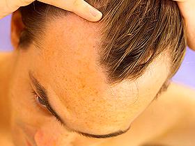 Hombres calvos son más propensos al cáncer de próstata