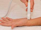 Ultrasonografía puede diagnosticar fracturas de mano en niños