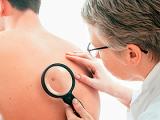 Nivolumab muestra más eficacia que la quimioterapia en melanoma avanzado