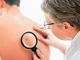 Nivolumab muestra más eficacia que la quimioterapia en melanoma avanzado