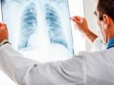 Corticoides reducen el fallo terapéutico en neumonías graves