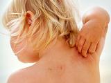 Pimecrolimus es seguro y eficaz en la dermatitis atópica infantil