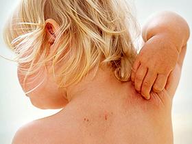 Pimecrolimus es seguro y eficaz en la dermatitis atópica infantil