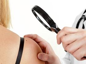Consumo de café puede reducir tasas de melanoma 