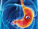 Calpaína-9 predice resultados clínicos del cáncer gástrico