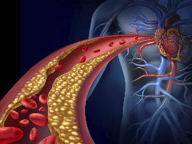 Anticuerpos monoclonales pueden prevenir la aterosclerosis