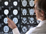 Aducanumab reduce las placas amiloides del Alzheimer