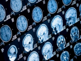 Virus Zika causa daño generalizado en el cerebro fetal