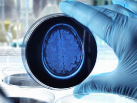 Fármaco reduce placas amiloides en pacientes con Alzheimer