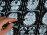 Cerebro sufre cambios estructurales durante un viaje espacial