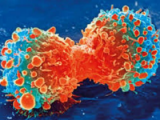 Alectinib es útil contra el cáncer pulmonar