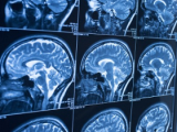 Neuroimagen funcional predice el autismo en infantes