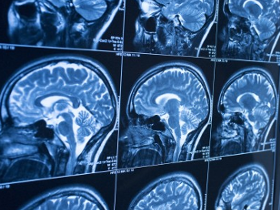 Neuroimagen funcional predice el autismo en infantes