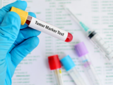 Biomarcadores para detección de adenocarcinoma pancreático