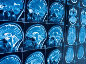 Infección por virus Zika eleva incidencia de neuropatologías
