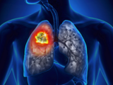 Durvalumab previene recurrencia de cáncer pulmonar 