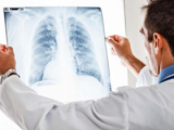 Proteínas séricas pronostican fibrosis pulmonar